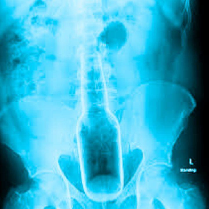 What was the most Embarrassing thing you've had to go to the ER for? What was the most Embarrassing thing you've had to go to the ER for?