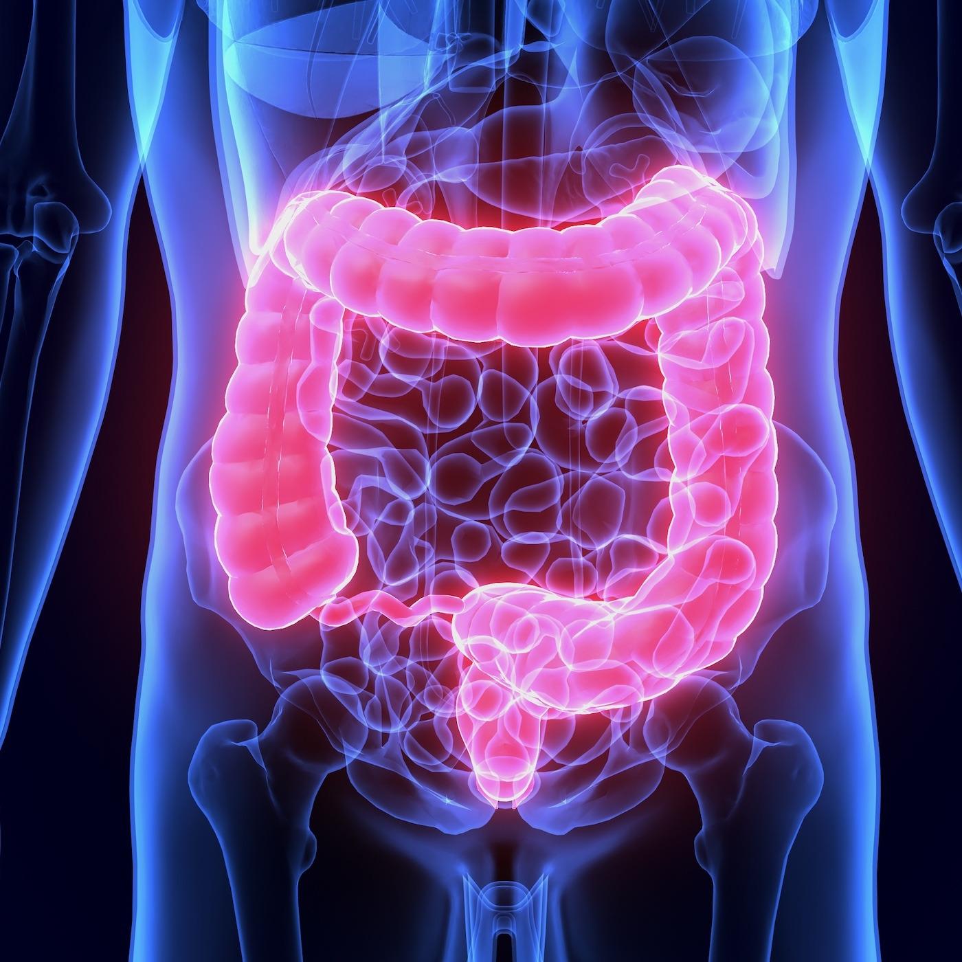 Diverticular Disease Diverticular Disease